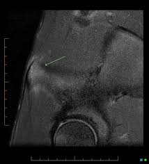 Image result for Hip Apophysitis