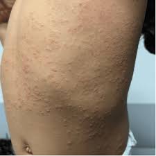 Image result for Papular Acrodermatitis