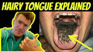 Image result for black hairy tongue symptoms