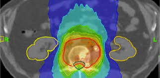 Radiotherapy is a key component of both radical (curative) and palliative treatment for cancer. Project To Improve Radiotherapy Planning University Of Cambridge