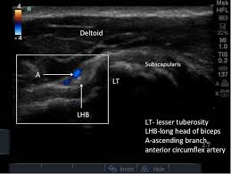 Image result for Biceps Tendon Injection