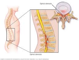 Check spelling or type a new query. Spinal Stenosis Symptoms And Causes Mayo Clinic
