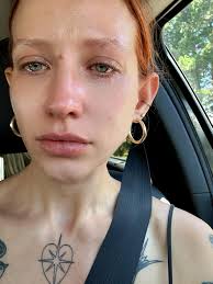 Cluster Headache Patients