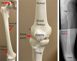External side of the chest muscle. Femoral Shaft Thigh Bone Fracture Orthopaedic Trauma Association Ota