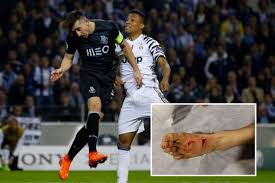 View all héctor herrera pictures. Porto Midfielder Hector Herrera Shows Off Gruesome Foot Injury Suffered During Defeat To Juventus Irish Mirror Online