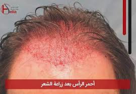 أحمر الرأس بعد زراعة الشعر In 2020 Behind Ear Tattoo Hair Transplant Ear Tattoo