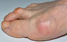 Image result for Hammer toe
