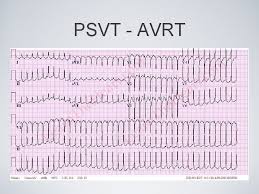 Svt is also called paroxysmal supraventricular tachycardia. Recognizing Cardiac Arrhythmias Normal Anatomy Normal Ecg Normal