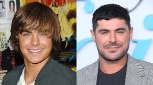 Zac Efron Face Before & After Surgery