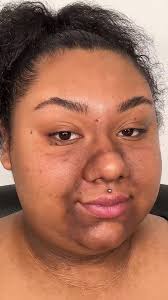 “I remember applying thick layers of foundation onto my skin just to hide  it”. When @Miahcarter was 8 she developed Acanthosis Nigracans. Other  people’s judgment and rude comments would give her ...