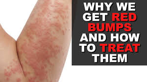 Jul 15, 2019 · vij recommends: This Is What Those Red Bumps At The Top Of Your Arms Are And How You Can Get Rid Of Them Cambridgeshire Live