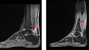 Der patient kann nicht mehr auf den zehenspitzen des betroffenen fußes stehen. Achillessehnenriss Diagnose Und Behandlungsmoglichkeiten Hirslanden Blog