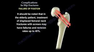 Image result for Fracture Complication