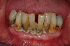 Resultado de imagem para placa bacteriana
