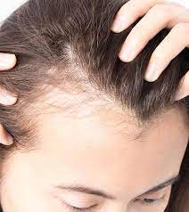 Fenugreek seeds are one of the best home remedies for thinning hair. 10 Home Remedies To Regrow Hair On Bald Patches