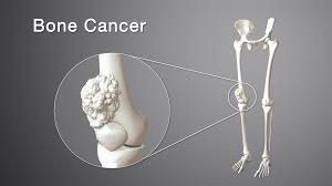 In bone cancer, bone or cartilage cells sometimes change and no longer grow or behave normally. Bone Cancer Types Symptoms Causes And Treatment Scientific Animations
