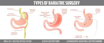 bariatric surgery the what the why