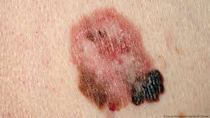 Melanoma is one the most common skin cancers patients experience. When Beauty Spots Turn Dangerous Science In Depth Reporting On Science And Technology Dw 15 05 2015