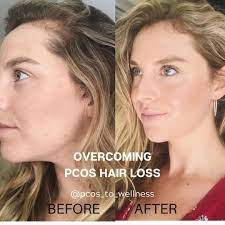 Has pcos made your hair fall out? Pin By Christine Newton On Pcos In 2021 Pcos Hair Loss Hormone Hair Loss Pcos