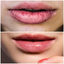 Roacutan - Isotretinoína- DANOS permanentes na Saúde - Roacutan -  Ressecamento Labial Permanente Você sabia que o ressecamento labial causado  pelo Roacutan (Isotretinoína) pode nunca mais voltar ao normal após o  tratamento?