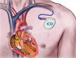 Esso viene impiantato chirurgicamente sottocute nella regione pettorale, preferibilmente a sinistra. Defibrillatore Cardiaco Impiantabile Af Ablation