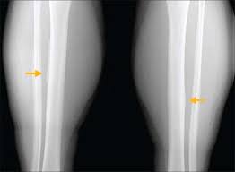 Image result for Tibia Stress Fracture