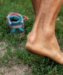 Haglund's deformity is a bony enlargement on the back of the heel. Houston Haglunds Deformity Specialist Bump On Back Of Heel Tanglewood Foot Specialists