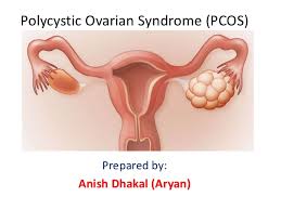 Polycystic ovary syndrome (pcos) is a chronic endocrine disorder that affects women of reproductive age and is associated with infertility, hyperandrogenism, hirsutism, metabolic disorders. Polycystic Ovarian Syndrome Pcos By Aryan