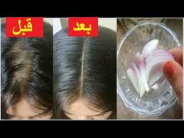 تجربتي مع ماء البصل والسدر لتساقط الشعر الخفيف Youtube