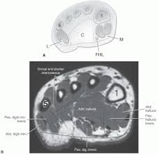 Trauma effects of direct injury or tear denervation injury: Foot Ankle And Calf Musculoskeletal Key