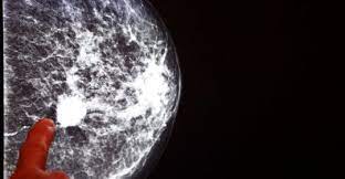 Cancerul mamar isi are originea in tesutul mamar, indeosebi in regiunea ductelor si a lobulilor. Chirurgia Cancerul La San Ce Trebuie Sa Stie Pacientii