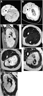 Unenhanced Ct Scan A Demonstrates A Well Defined Heterogeneous Deep Download Scientific Diagram