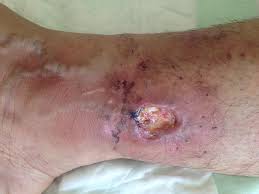 It was first identified by the spanish cardiologist fernando martorell in 1945, who referred to the ulcers as 'hypertensive ischaemic ulcers'. Venous Leg Ulceration Intechopen