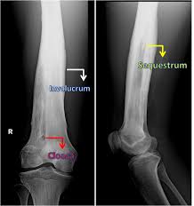 A Sequestrum Is Usually A Complication Of Osteomyelitis And Represents Devascularisation Of A Portion Of Bone With Radiology Medical Studies Radiology Imaging