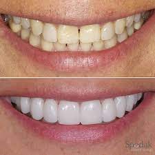 Veneers Before And After Smile Teeth Porcelain Veneers White Teeth