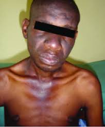 Image result for Photodermatitis