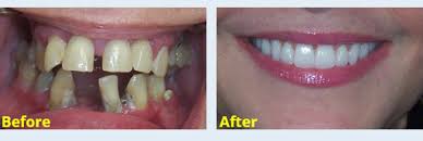 A useful tip for you on best natural looking dentures: Denture Fittings Full And Partial Dentures Newnan Ga