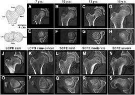 In the united kingdom, the incidence of. Statistical Shape Modeling Of Proximal Femoral Shape Deformities In Legg Calve Perthes Disease And Slipped Capital Femoral Epiphysis Osteoarthritis And Cartilage