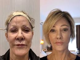 Andrew Jacono, MD-The New York Center for Facial Plastic and Laser Surgery 