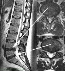 Prof Dr Christian Woiciechowsky Neurochirurgie Berlin Activ L Bandscheibenendoprothese Lws