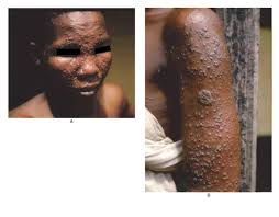 Image result for Smallpox