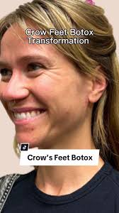 CapCut Just a bit of #Botox and crow's feet around the eyes can disap...