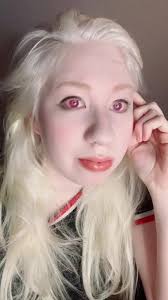 Cranial Facial Dysplasia Kayla