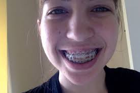 Fundraiser by Stephanie Kehr : Jaw Surgery for Kay