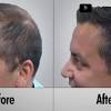 Microneedling is typically performed by a professional medical aesthetician or. Https Encrypted Tbn0 Gstatic Com Images Q Tbn And9gcrz84ds24nwvbitx4pppu26wwp1qgvdq76jib4ifjfx2frm872q Usqp Cau
