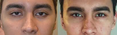 The final result that banobagi ultimately pursues is this: Almond Eye Surgery In Beverly Hills Dr Taban Almond Eye Specialist