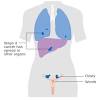 Ovarian cancer is a type of cancer that affects one or both of your ovaries and usually occurs later in life. 1
