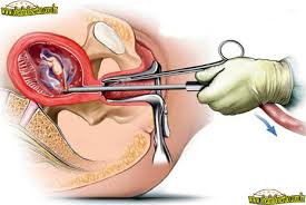 Resultado de imagen para el aborto en adolescentes