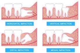 Wisdom panel sent us the wisdom panel health dna test to try for free in exchange for an unbiased review. 8 Things You Need To Know About Wisdom Teeth Tds Singapore