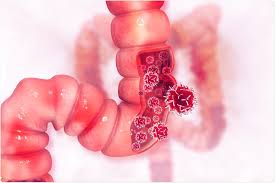 Colon cancer is a malignancy that begins in the colon or large intestine. Cancer Killing Virus Activates Immune System Against Colon Cancer